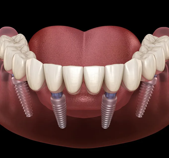 A Permanent Solution for Missing Teeth